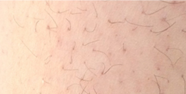 Laser Hair Removal